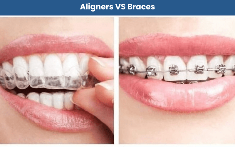 Aligners