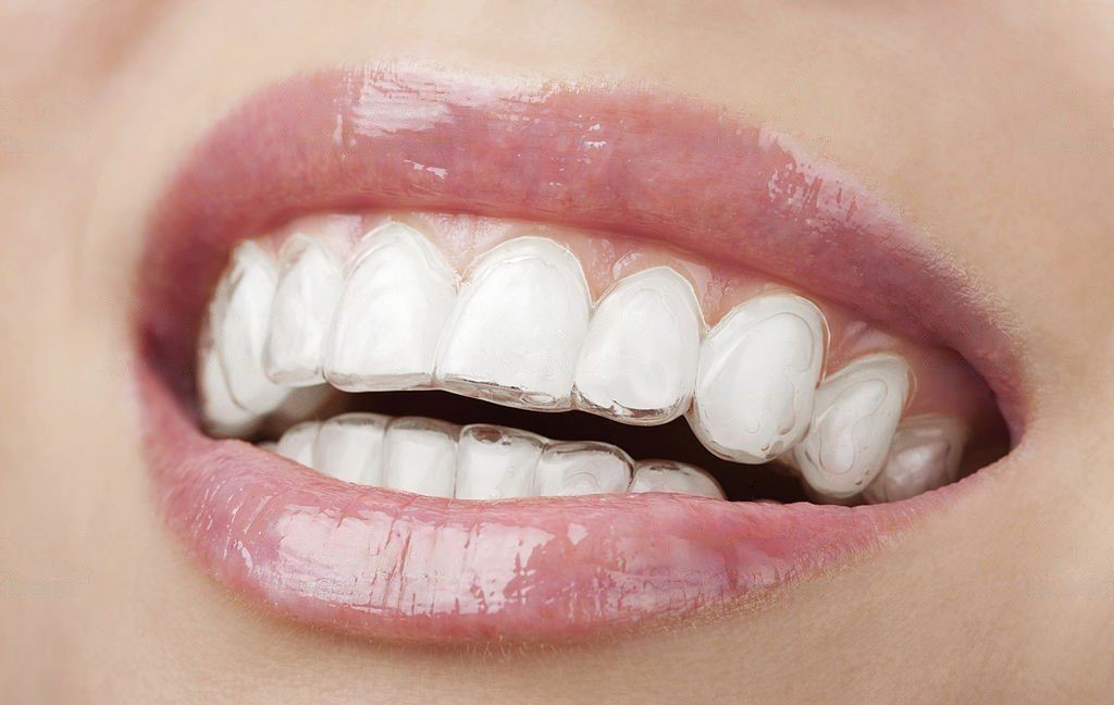 Aligners