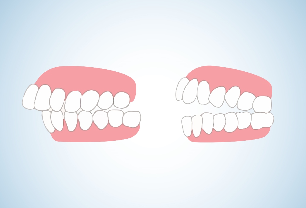 Aligners